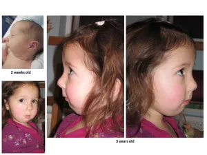 Cleft lip and palate before and after