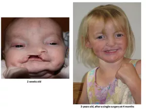 Cleft lip and palate before and after